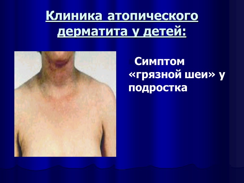 Клиника атопического дерматита у детей: Симптом «грязной шеи» у подростка